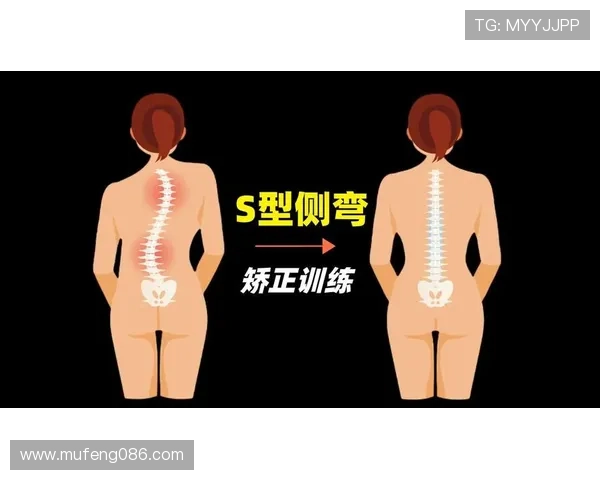 科学干预与康复训练结合的青少年脊柱侧弯运动矫正策略研究实践探索